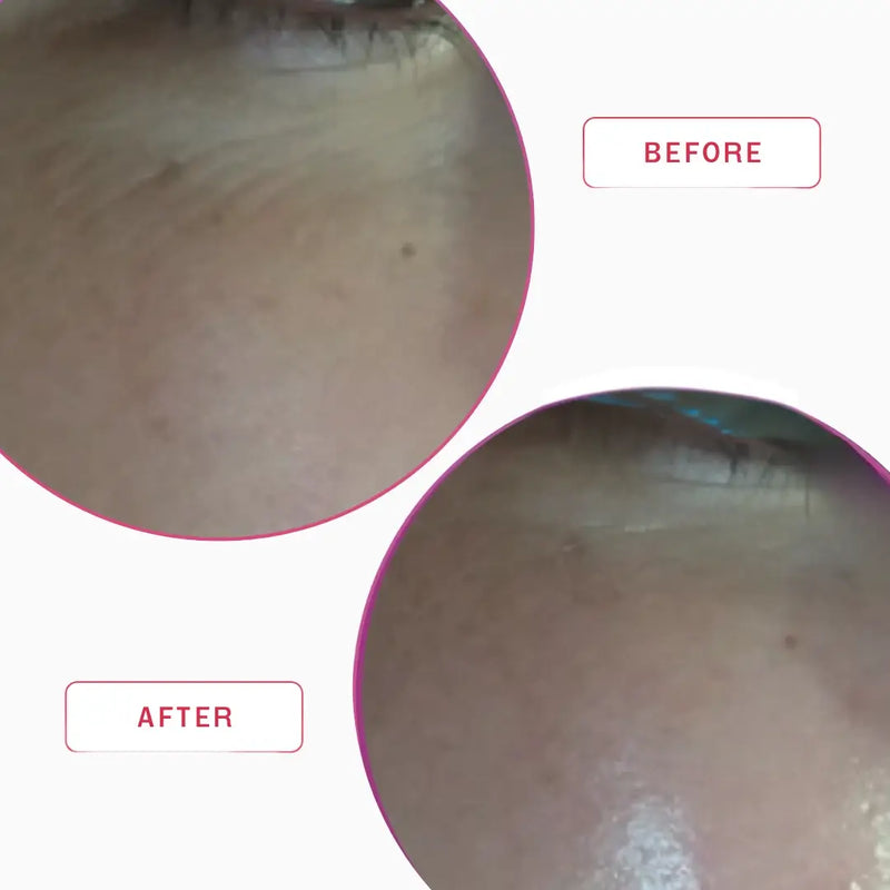 Smartker Professional Hyaluronic